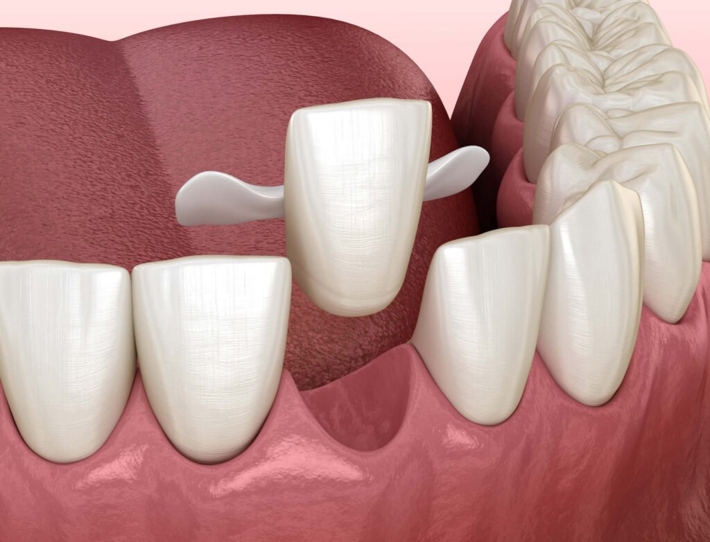 Maryland bridge anterior missing tooth dental