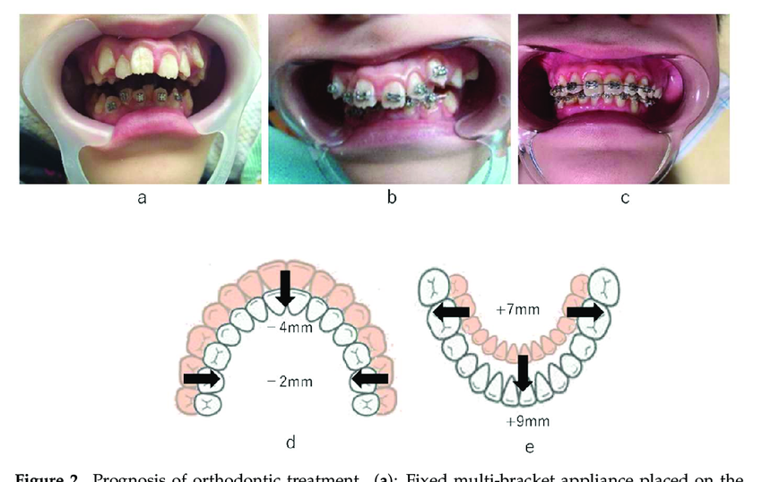 fixed orthodontic braces multibracket appliance dental