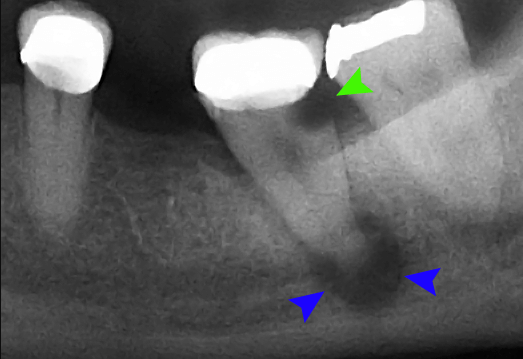 periapical abscess x-ray radiograph
