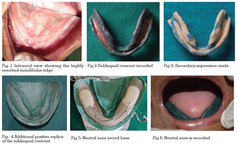 mandibular complete denture impression sublingual