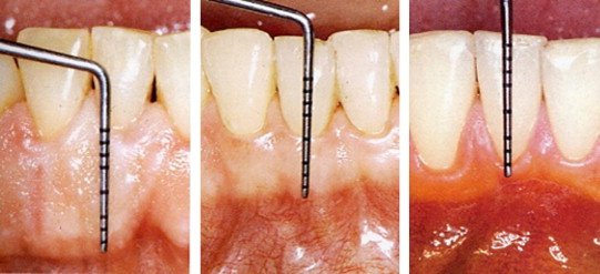 test mobilité dentaire deux instruments clinique