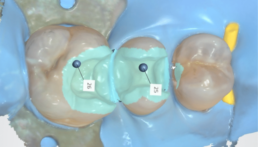 intraoral scanner 3D scan posterior teeth