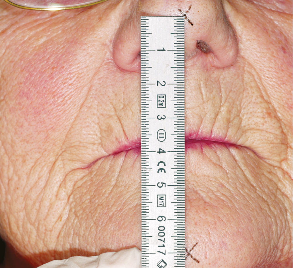 🔍 dimension verticale occlusion prothèse amovible