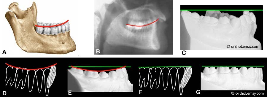 🔍 courbe de Spee plan occlusal prothèse dentaire