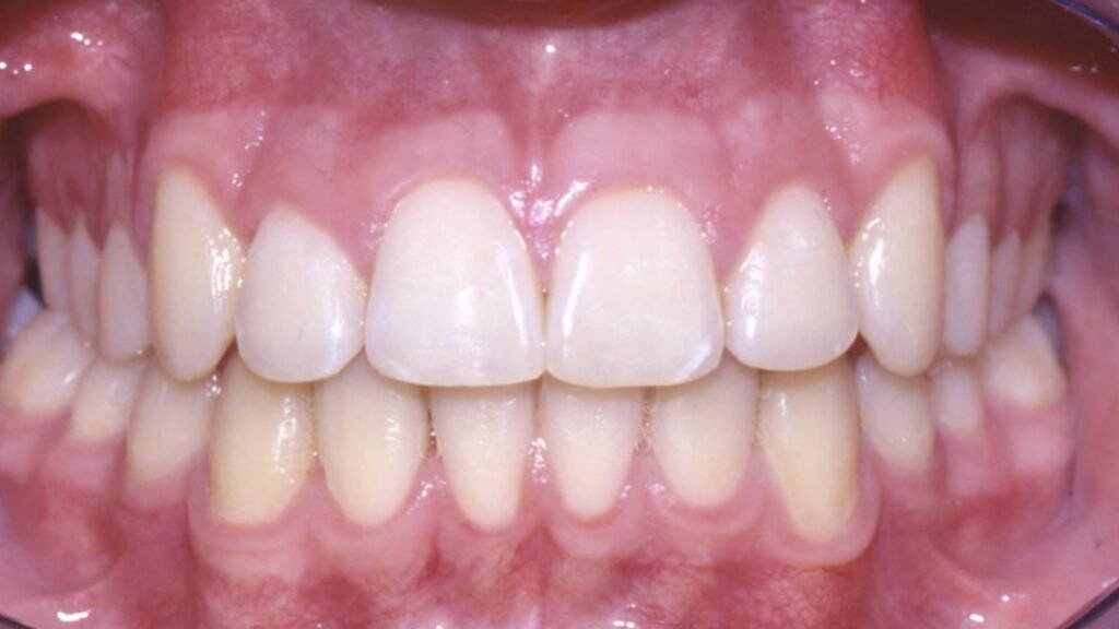 occlusion dentaire vue clinique bouche ouverte