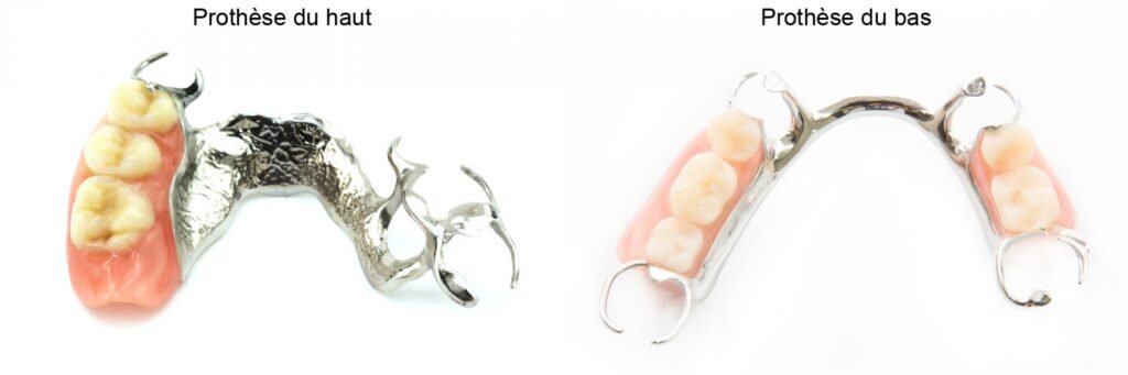 🔍 prothèse partielle amovible châssis métallique