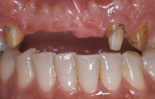 anterior bridge dental prosthesis