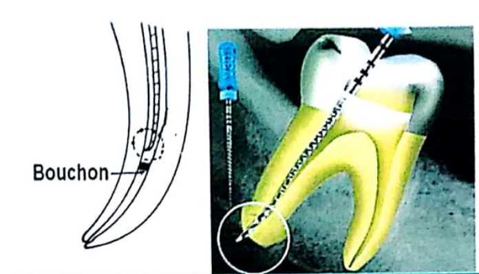 ACCIDENTS AU COURS DES TRAITEMENTS ENDODONTIQUES