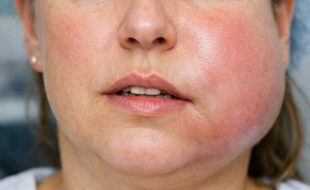 Image clinique montrant une tuméfaction de la joue, asymétrie faciale due à une infection dentaire, photographie médicale professionnelle