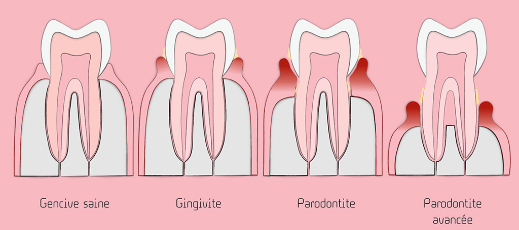 L'Inflammation : Processus de Nettoyage et de Préparation