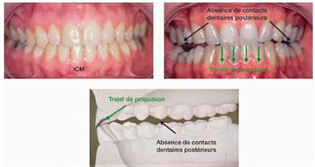  La propulsion par les incisives 