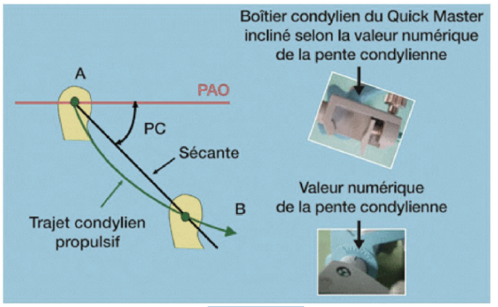 La pente condylienne