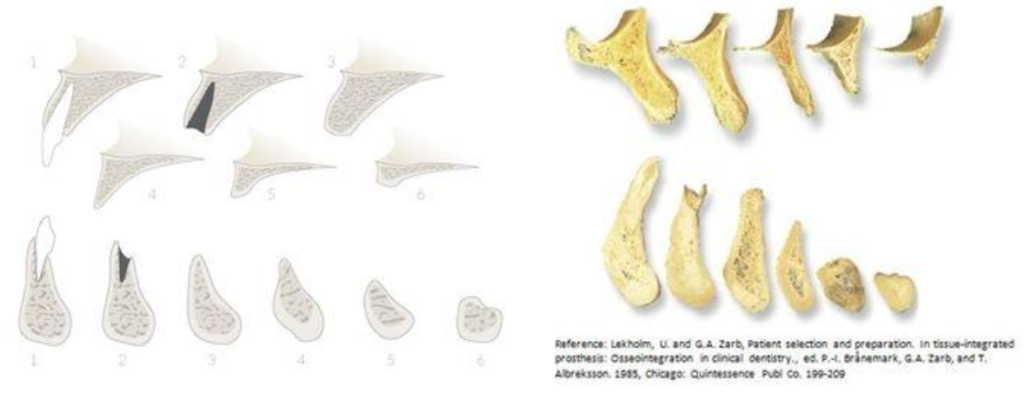 mandibular bone resorption edentulous atwood classification