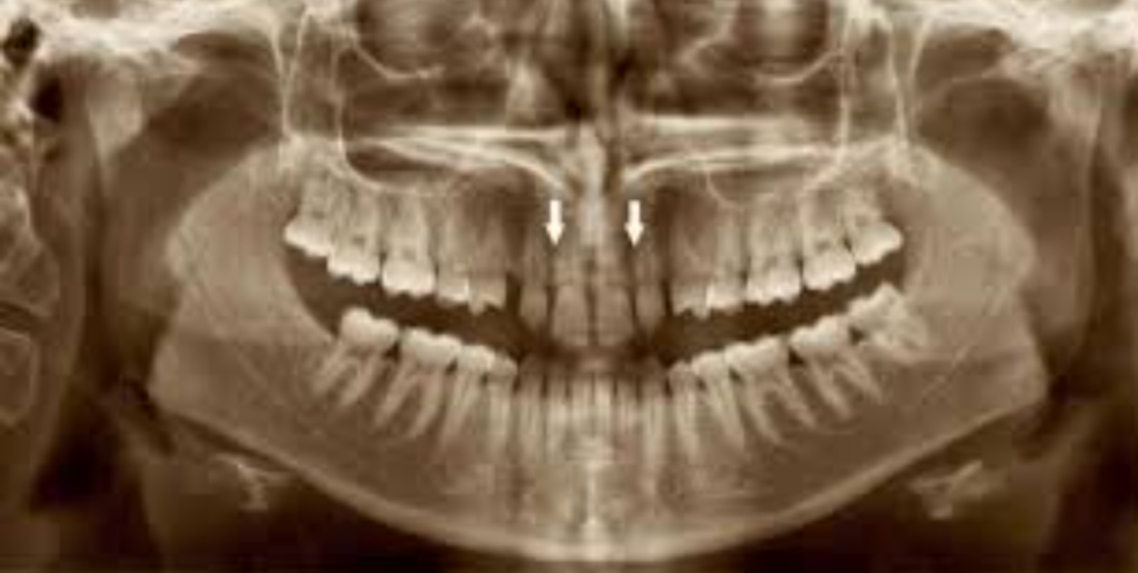 dental panoramic x-ray missing lateral incisor agenesis