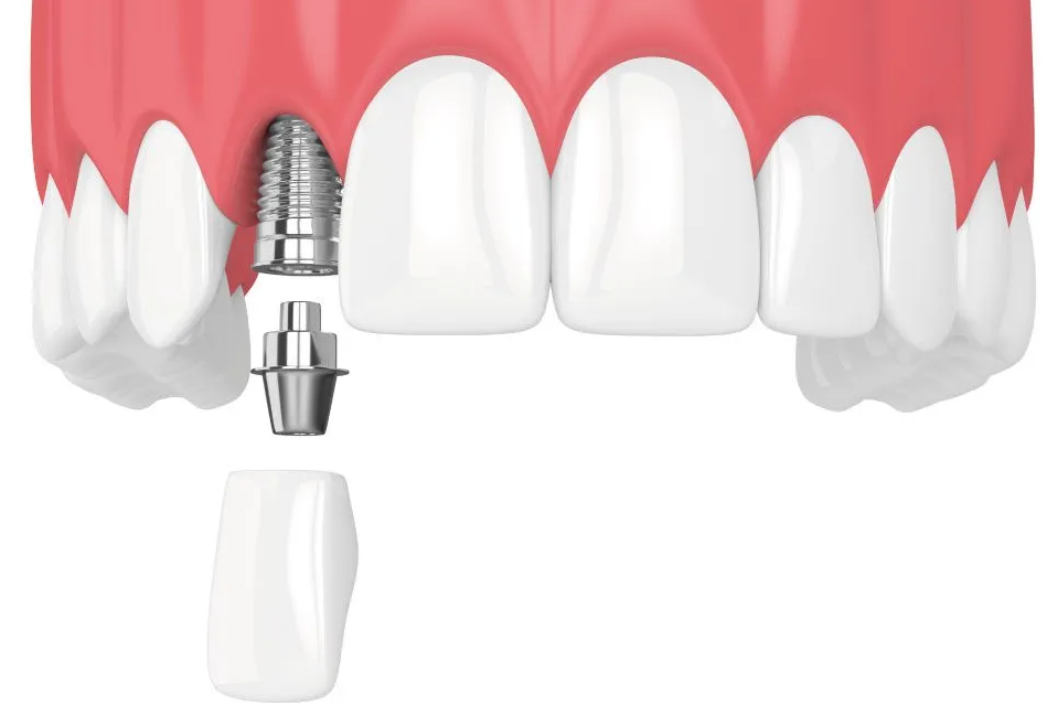 single dental implant anterior upper jaw illustration