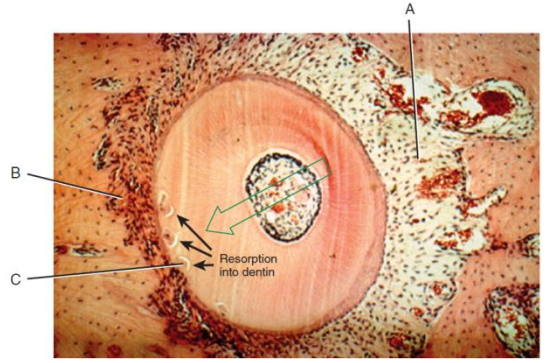 A. Vasodilatation + Activité ostéoblastique
B. Les oséoclastes détruisent la trame osseuse
alvéolaire
C. Zones de début de résorption qui seront
réparées par une apposition cémentaire
