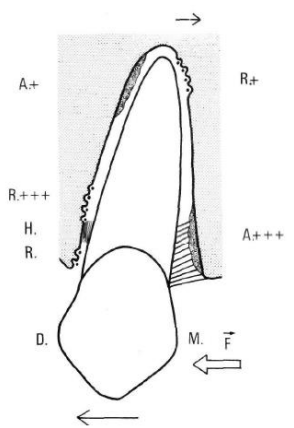 Mouvement de version
A = apposition;
R = résorption:
H = hyalinisalion.