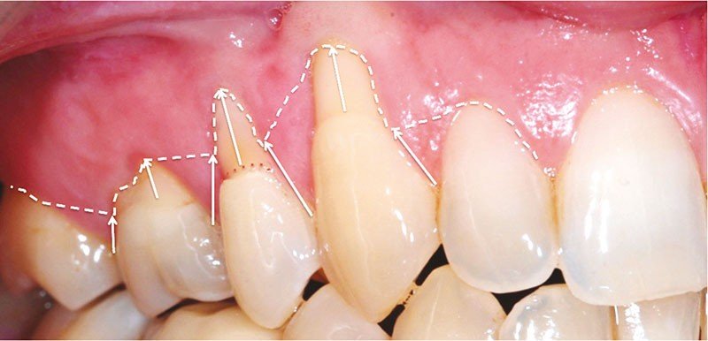 récession gingivale classification forme U V I