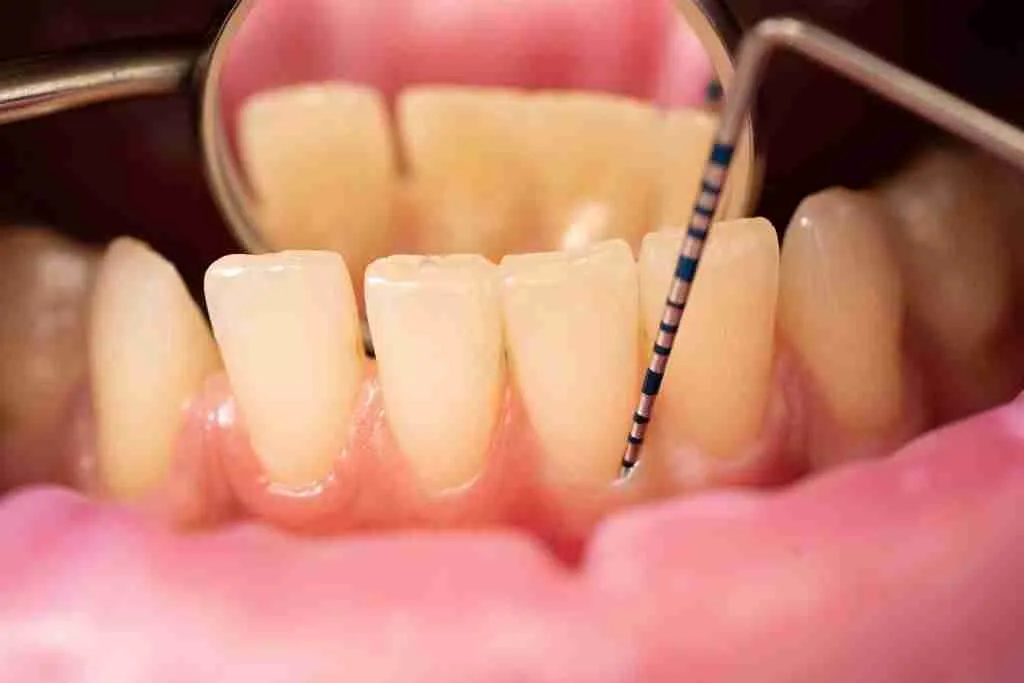 sonde parodontale raclage plaque dentaire