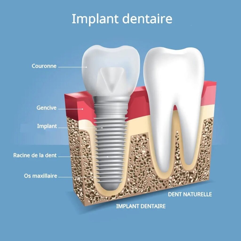 implant dentaire coupe transversale schéma