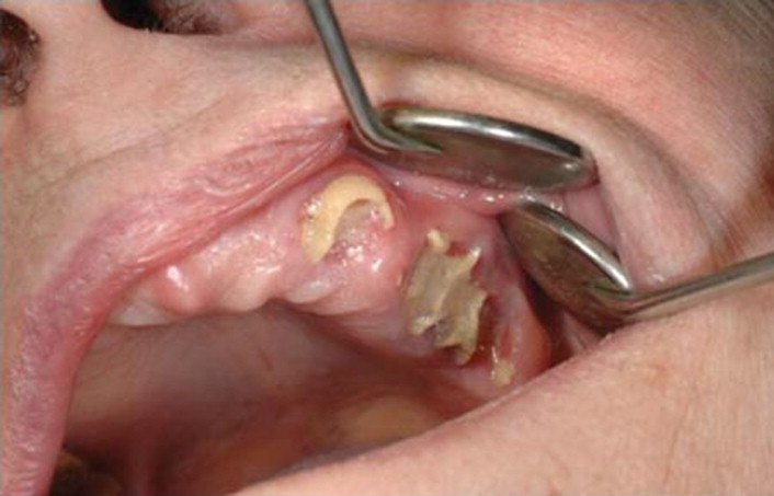 Ostéonécrose de la mâchoire (image radiologique ou clinique) — illustrer la complication

