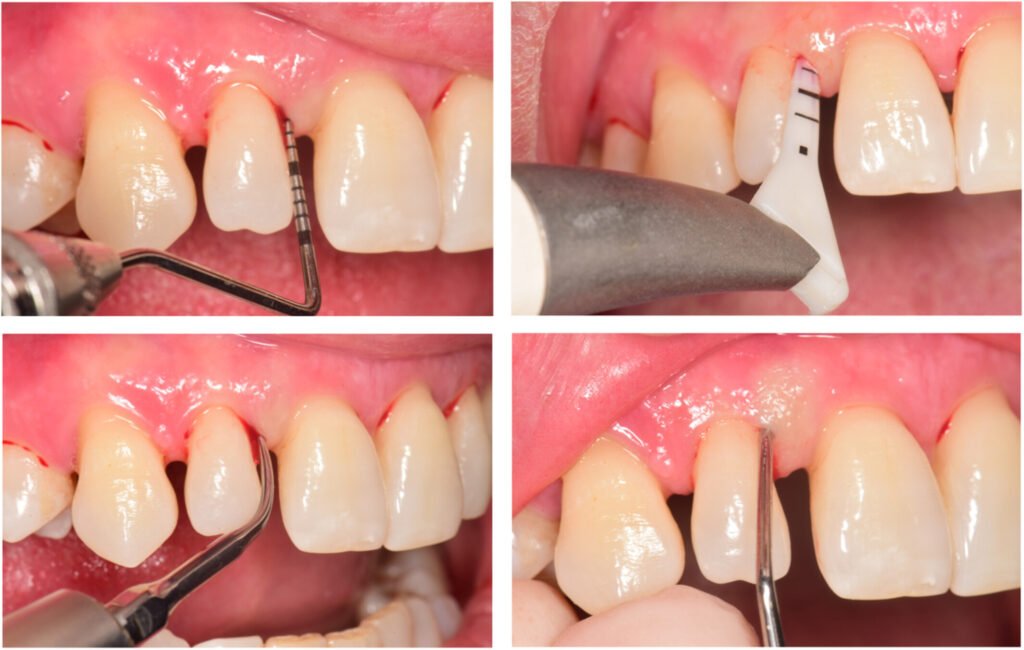  curetage parodontal instrument chirurgical dentaire