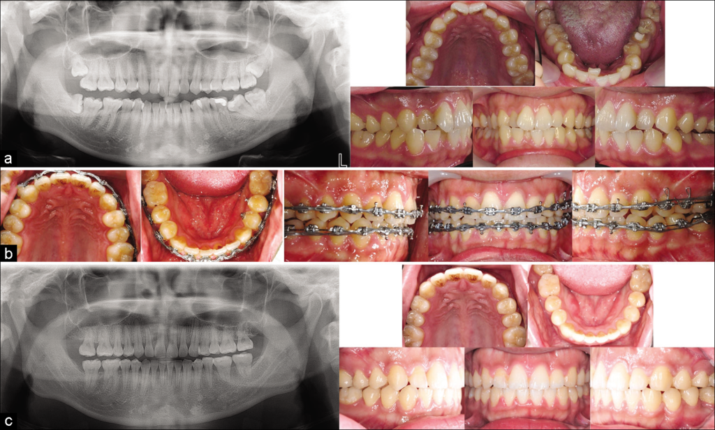 mandibular molar mesial drift space closure orthodontics diagram