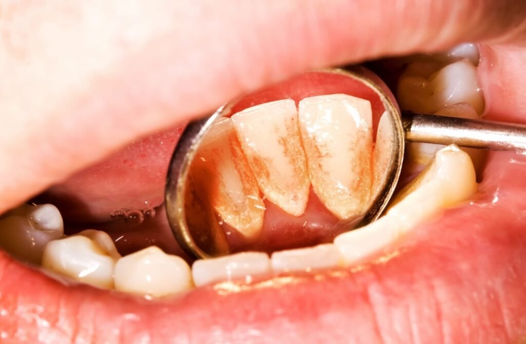 Photo clinique montrant différents niveaux de dépôts de plaque, idéalement sur dents antérieures.