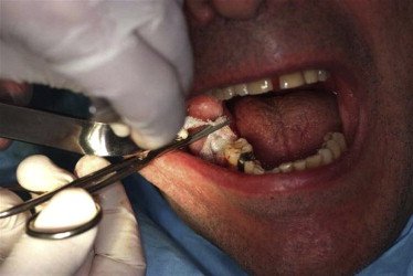 Hémostase locale — compresse / suture post-extraction — illustrer les techniques locales

