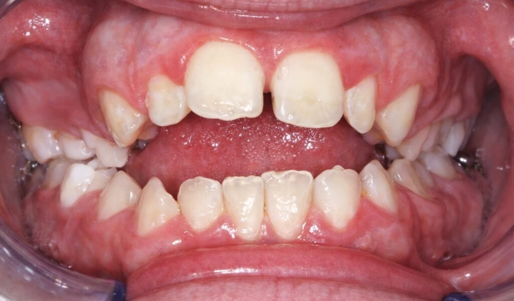 Classification : DDM par excès vs DDM par défaut