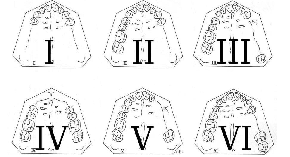 Schéma illustrant les 4 classes d'édentement de Kennedy (vues occlusales des arcades)