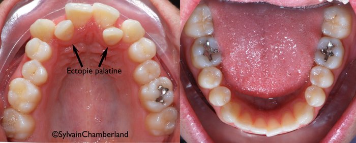 vue occlusale montrant l'arcade maxillaire étroite et le croisement postérieur