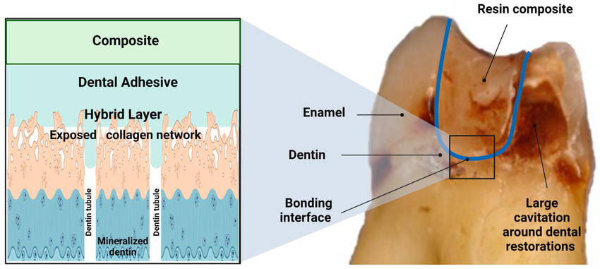 dental bonding adhesion teeth diagram