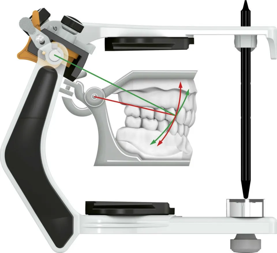 L'articulateur semi-adaptable permet de vérifier et corriger les contacts en mouvements excentrés