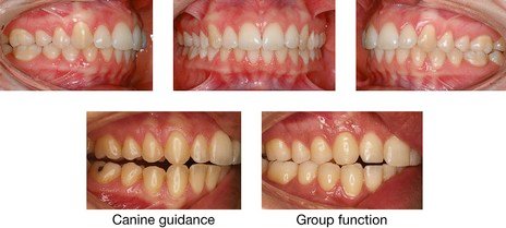 occlusal concepts comparison canine guidance group function balanced occlusion diagram