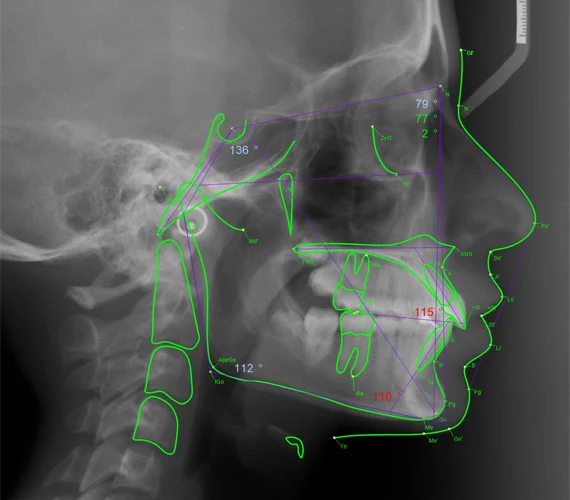 Analyse céphalométrique profil