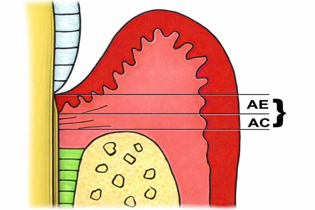 Définition de l’Attache Épithéliale