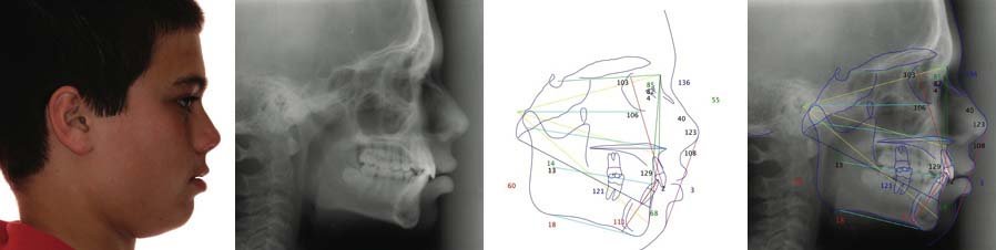 Examen orthodontique céphalométrique