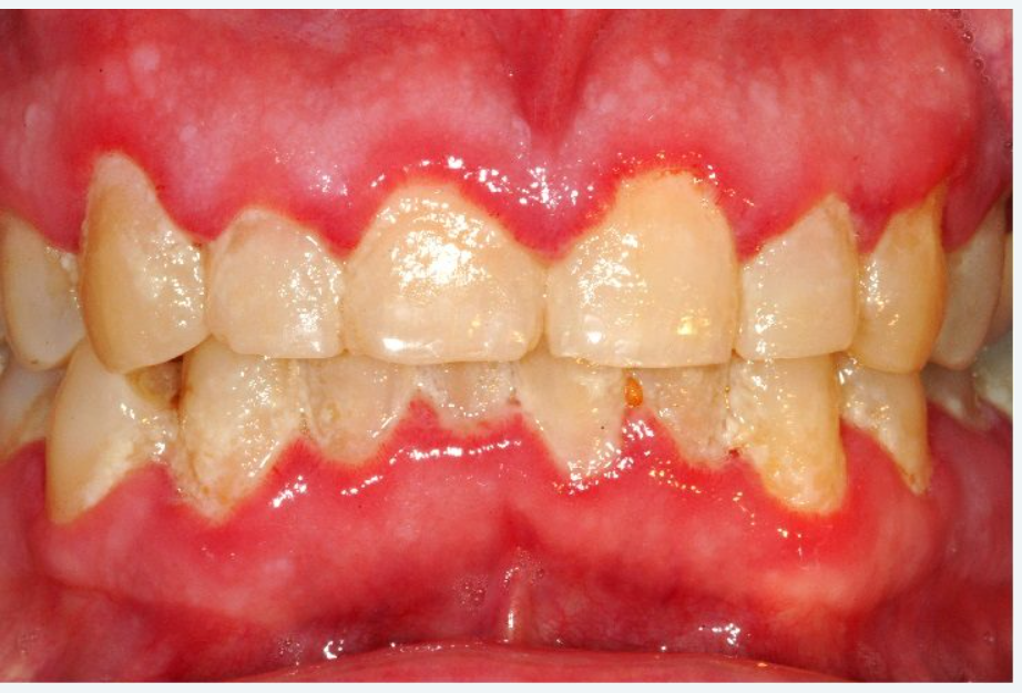 chronic marginal gingivitis clinical photo