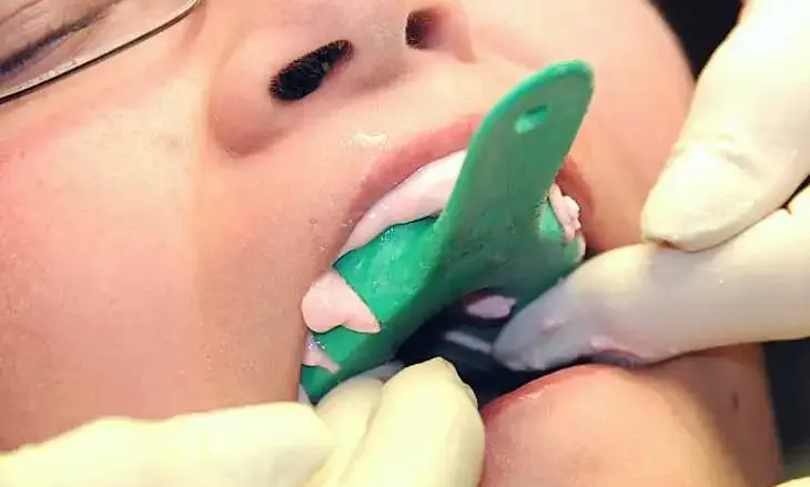 maxillary dental impression tray in mouth clinical