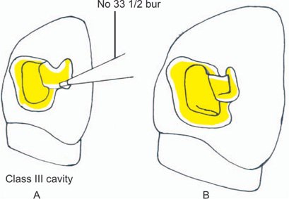 class III complex cavity dovetail diagram cavité complexe classe III queue d'aronde schéma