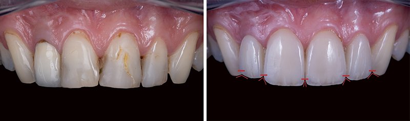 incisives canines dents antérieures proximale, sourire dents blanches face, front teeth close up