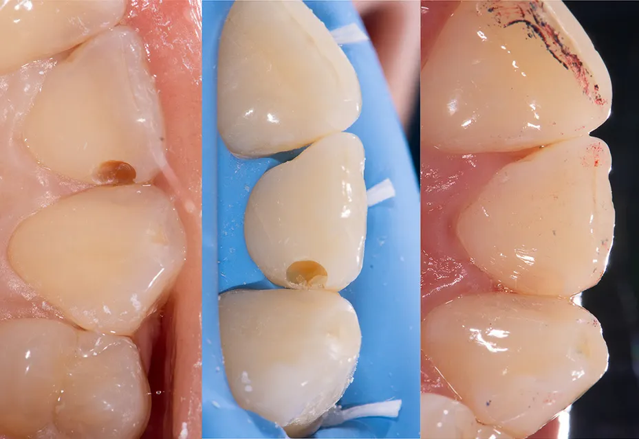 composite restoration anterior teeth result restauration composite antérieure avant après