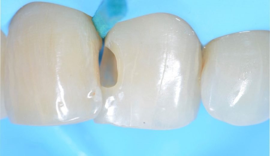 Dent antérieure — zone proximale concernée par la classe III