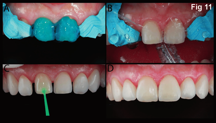 phosphoric acid etch dental procedure clinical