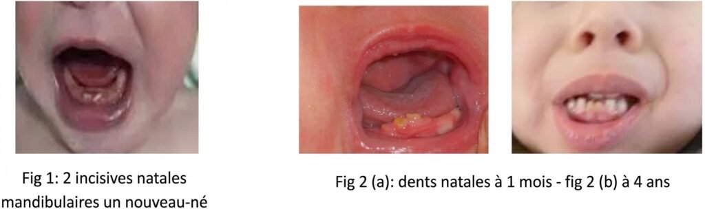 Les Éruptions Précoces