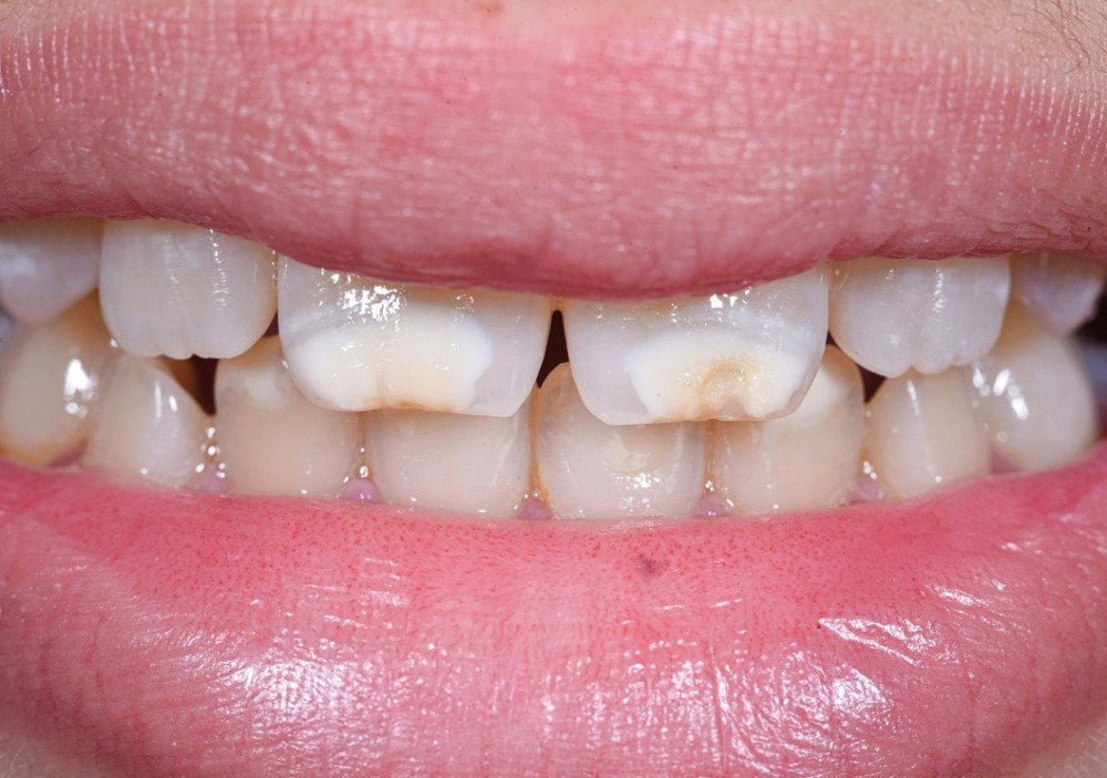 MIH hypominéralisation dent enfant