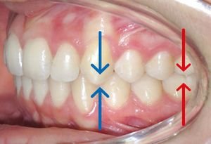 Position des incisives orthodontie