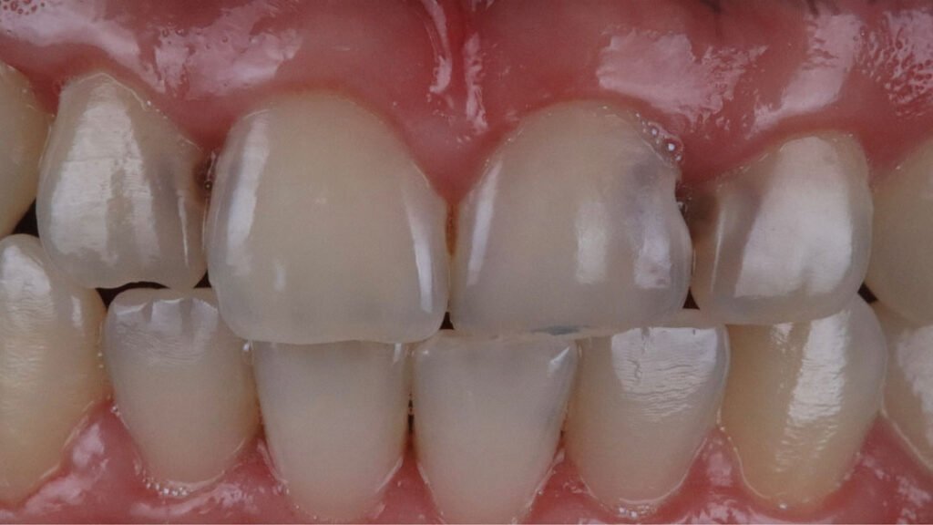class III cavity clinical photo, proximal caries anterior tooth