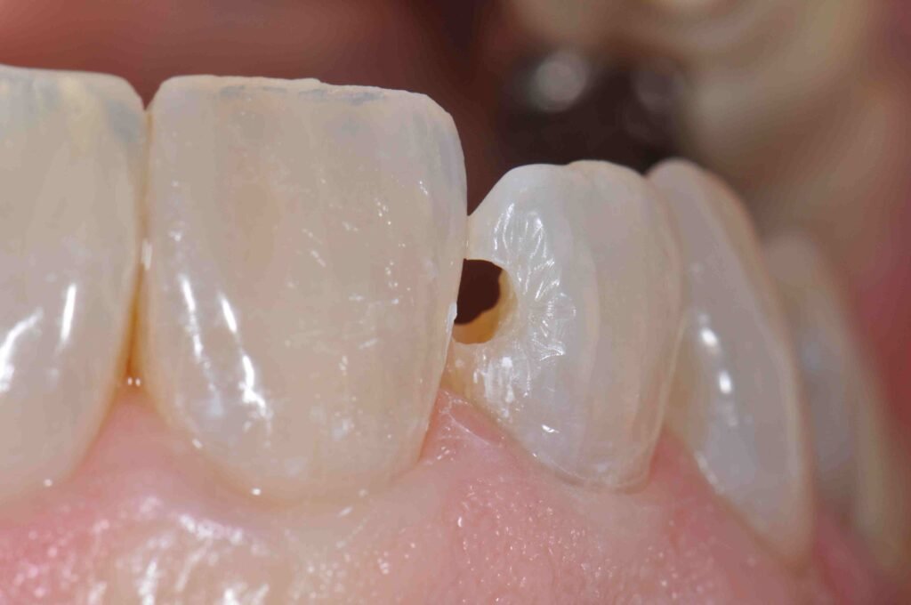 biseau émail composite classe III